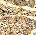 HSP70L1 / HSPA14 Antibody - Formalin-fixed and paraffin-embedded human lung carcinoma with Hsp 60 Antibody , which was peroxidase-conjugated to the secondary antibody, followed by DAB staining. This data demonstrates the use of this antibody for immunohistochemistry; clinical relevance has not been evaluated.