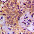 HSP90AB1 / HSP90 Alpha B1 Antibody - Immunohistochemical analysis of HSP90 beta (pS254) staining in human breast cancer formalin fixed paraffin embedded tissue section. The section was pre-treated using heat mediated antigen retrieval with sodium citrate buffer (pH 6.0). The section was then incubated with the antibody at room temperature and detected using an HRP conjugated compact polymer system. DAB was used as the chromogen. The section was then counterstained with hematoxylin and mounted with DPX.