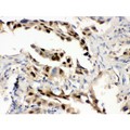 HSPA1A Antibody - Hsp70 antibody IHC-paraffin. IHC(P): Human Lung Cancer Tissue.