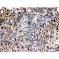 HSPA2 Antibody - HSPA2 antibody IHC-paraffin. IHC(P): Human Lung Cancer Tissue.