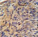 HSPA5 / GRP78 / BiP Antibody - HSPA5 Antibody IHC of formalin-fixed and paraffin-embedded human lung carcinoma followed by peroxidase-conjugated secondary antibody and DAB staining.