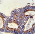 HSPA5 / GRP78 / BiP Antibody - HSPA5 Antibody immunohistochemistry of formalin-fixed and paraffin-embedded human colon carcinoma followed by peroxidase-conjugated secondary antibody and DAB staining.