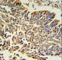 HSPB1 / HSP27 Antibody - Hsp 27 Antibody IHC of formalin-fixed and paraffin-embedded human Lung carcinoma followed by peroxidase-conjugated secondary antibody and DAB staining.
