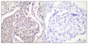 HSPB6 / HSP20 Antibody - Immunohistochemistry analysis of paraffin-embedded human breast carcinoma, using HSP20 (Phospho-Ser16) Antibody. The picture on the right is blocked with the phospho peptide.