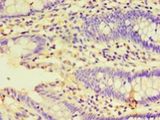 HSPBAP1 Antibody - Immunohistochemistry of paraffin-embedded human colon cancer using antibody at 1:100 dilution.  This image was taken for the unconjugated form of this product. Other forms have not been tested.