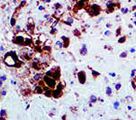 HSV-2 / Herpes Simplex Virus 2 Antibody - IHC of HSV II on FFPE Infected tissue. This image was taken for the unmodified form of this product. Other forms have not been tested.