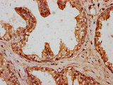 HT036 / HYI Antibody - Immunohistochemistry Dilution at 1:400 and staining in paraffin-embedded human prostate cancer performed on a Leica BondTM system. After dewaxing and hydration, antigen retrieval was mediated by high pressure in a citrate buffer (pH 6.0). Section was blocked with 10% normal Goat serum 30min at RT. Then primary antibody (1% BSA) was incubated at 4°C overnight. The primary is detected by a biotinylated Secondary antibody and visualized using an HRP conjugated SP system.