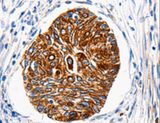 HTR1A / 5-HT1A Receptor Antibody - Immunohistochemistry of paraffin-embedded Human cervical cancer using HTR1A Polyclonal Antibody at dilution of 1:100.