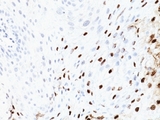 Human Papilloma Virus 16 Antibody - Formalin-fixed, paraffin-embedded human cervix stained with HPV-16 antibody (SPM405).  This image was taken for the unmodified form of this product. Other forms have not been tested.