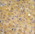 HURP / DLGAP5 Antibody - DLG7 Antibody IHC of formalin-fixed and paraffin-embedded hepatocarcinoma followed by peroxidase-conjugated secondary antibody and DAB staining.