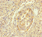 HYPM / CXorf27 Antibody - Immunohistochemistry of paraffin-embedded human pancreatic cancer using HYPM Antibody at dilution of 1:100