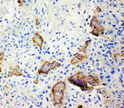 IBSP / Bone Sialoprotein Antibody - IBSP / Bone Sialoprotein antibody. IHC(P): Human Osteosarcoma Tissue.