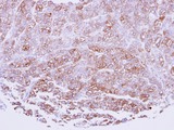 ICAM2 / CD102 Antibody - IHC of paraffin-embedded breast cancer using ICAM2 antibody at 1:100 dilution.