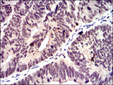 ID2 Antibody - IHC of paraffin-embedded rectum cancer tissues using ID2 mouse monoclonal antibody with DAB staining.