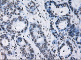ID3 Antibody - IHC of paraffin-embedded Adenocarcinoma of colon tissue using anti-ID3 mouse monoclonal antibody. (Dilution 1:50).