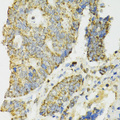 IDH2 Antibody - Immunohistochemistry of paraffin-embedded human colon carcinoma tissue.
