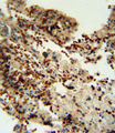 IDO1 / IDO Antibody - INDO antibody immunohistochemistry of formalin-fixed and paraffin-embedded human lung carcinoma followed by peroxidase-conjugated secondary antibody and DAB staining.
