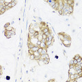 IER3 / IEX-1 Antibody - Immunohistochemistry of paraffin-embedded human gastric cancer tissue.