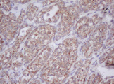 IF3mt / MTIF3 Antibody - IHC of paraffin-embedded Carcinoma of Human thyroid tissue using anti-MTIF3 mouse monoclonal antibody. (Heat-induced epitope retrieval by 10mM citric buffer, pH6.0, 100C for 10min).