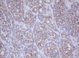 IF3mt / MTIF3 Antibody - IHC of paraffin-embedded Carcinoma of Human thyroid tissue using anti-MTIF3 mouse monoclonal antibody.