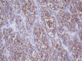 IF3mt / MTIF3 Antibody - IHC of paraffin-embedded Carcinoma of Human thyroid tissue using anti-MTIF3 mouse monoclonal antibody.