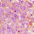 IFIH1 / MDA5 Antibody - Immunohistochemical analysis of MDA5 staining in human breast cancer formalin fixed paraffin embedded tissue section. The section was pre-treated using heat mediated antigen retrieval with sodium citrate buffer (pH 6.0). The section was then incubated with the antibody at room temperature and detected using an HRP conjugated compact polymer system. DAB was used as the chromogen. The section was then counterstained with hematoxylin and mounted with DPX.