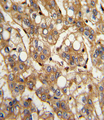 IFN Beta / Interferon Beta Antibody - Formalin-fixed and paraffin-embedded human hepatocarcinoma with IFNB1 Antibody , which was peroxidase-conjugated to the secondary antibody, followed by DAB staining. This data demonstrates the use of this antibody for immunohistochemistry; clinical relevance has not been evaluated.