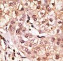 IFNL1 / IL29 Antibody - Formalin-fixed and paraffin-embedded human cancer tissue reacted with the primary antibody, which was peroxidase-conjugated to the secondary antibody, followed by DAB staining. This data demonstrates the use of this antibody for immunohistochemistry; clinical relevance has not been evaluated. BC = breast carcinoma; HC = hepatocarcinoma.