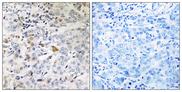 IFT22 / RABL5 Antibody - Peptide - + Immunohistochemistry analysis of paraffin-embedded human breast carcinoma tissue using RABL5 antibody.