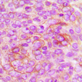 IGF2R / CD222 Antibody - Immunohistochemical analysis of CD222 staining in human breast cancer formalin fixed paraffin embedded tissue section. The section was pre-treated using heat mediated antigen retrieval with sodium citrate buffer (pH 6.0). The section was then incubated with the antibody at room temperature and detected using an HRP conjugated compact polymer system. DAB was used as the chromogen. The section was then counterstained with hematoxylin and mounted with DPX.
