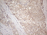 IGFBP1 Antibody - Immunohistochemical staining of paraffin-embedded Adenocarcinoma of Human endometrium tissue using anti-IGFBP1 mouse monoclonal antibody. (Heat-induced epitope retrieval by 1mM EDTA in 10mM Tris buffer. (pH8.5) at 120°C for 3 min. (1:150)