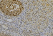 IGFBP1 Antibody - 1:100 staining human uterus tissue by IHC-P. The sample was formaldehyde fixed and a heat mediated antigen retrieval step in citrate buffer was performed. The sample was then blocked and incubated with the antibody for 1.5 hours at 22°C. An HRP conjugated goat anti-rabbit antibody was used as the secondary.