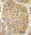 IGFBP3 Antibody - Formalin-fixed and paraffin-embedded human hepatocarcinoma tissue reacted with IGFBP3 Antibody , which was peroxidase-conjugated to the secondary antibody, followed by DAB staining. This data demonstrates the use of this antibody for immunohistochemistry; clinical relevance has not been evaluated.