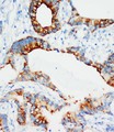 IGFBP3 Antibody - IGFBP3 / IGFBP-3 antibody. IHC(P): Human Breast Cancer Tissue.