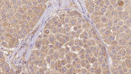 IGFL1 Antibody - 1:100 staining human Melanoma tissue by IHC-P. The sample was formaldehyde fixed and a heat mediated antigen retrieval step in citrate buffer was performed. The sample was then blocked and incubated with the antibody for 1.5 hours at 22°C. An HRP conjugated goat anti-rabbit antibody was used as the secondary.