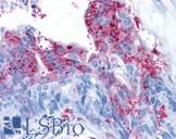 ADGRA2 / GPR124 Antibody - Anti-GPR124 / TEM5 antibody IHC of human Colon, Carcinoma. Immunohistochemistry of formalin-fixed, paraffin-embedded tissue after heat-induced antigen retrieval.