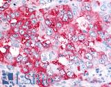 BEST4 Antibody - Anti-BEST4 antibody IHC of human Lung, Non-Small Cell Carcinoma. Immunohistochemistry of formalin-fixed, paraffin-embedded tissue after heat-induced antigen retrieval.