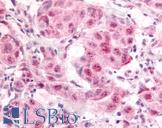 E2F1 Antibody - Anti-E2F1 antibody IHC of human breast carcinoma. Immunohistochemistry of formalin-fixed, paraffin-embedded tissue after heat-induced antigen retrieval. Antibody concentration 10 ug/ml.