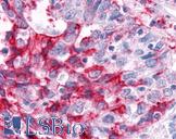 ESRRA / ERR Alpha Antibody - Anti-ESRRA / ERR Alpha antibody IHC of human Ovary, Carcinoma. Immunohistochemistry of formalin-fixed, paraffin-embedded tissue after heat-induced antigen retrieval.