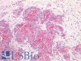 FZD7 / Frizzled 7 Antibody - Human Breast Carcinoma: Formalin-Fixed, Paraffin-Embedded (FFPE)