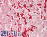 Hemoglobin Antibody - Human Liver, Hepatocytes and Erythrocytes: Formalin-Fixed, Paraffin-Embedded (FFPE)
