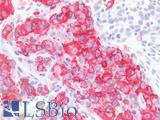 HMB45 Antibody - Human Skin, Melanoma: Formalin-Fixed, Paraffin-Embedded (FFPE)