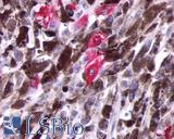 OPN5 / Neuropsin Antibody - Anti-OPN5 antibody IHC of human Skin, Melanoma. Immunohistochemistry of formalin-fixed, paraffin-embedded tissue after heat-induced antigen retrieval.