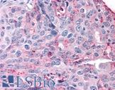 SGK3 Antibody - Anti-SGK3 antibody IHC of human Ovary, Carcinoma. Immunohistochemistry of formalin-fixed, paraffin-embedded tissue after heat-induced antigen retrieval.