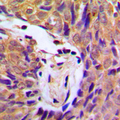 IKK Alpha+Beta Antibody - Immunohistochemical analysis of IKK alpha/beta (pS180/181) staining in human breast cancer formalin fixed paraffin embedded tissue section. The section was pre-treated using heat mediated antigen retrieval with sodium citrate buffer (pH 6.0). The section was then incubated with the antibody at room temperature and detected using an HRP conjugated compact polymer system. DAB was used as the chromogen. The section was then counterstained with hematoxylin and mounted with DPX.