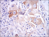 IL-1B / IL-1 Beta Antibody - IHC of paraffin-embedded lung cancer tissues using IL1B mouse monoclonal antibody with DAB staining.