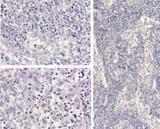 IL-1B / IL-1 Beta Antibody - Immunohistochemistry of Human IL1 beta antibody. Tissue: medullary lymph node. Fixation: formalin fixed paraffin embedded. Antigen retrieval: user optimized. Primary antibody: Human IL1 beta antibody. Secondary antibody: Peroxidase goat anti-rabbit at 1:10,000 for 45 min at RT. Localization: cytoplasm. Staining: Close up of medullary lymph node: positive staining in the cytoplasm of circulating macrophages. Neg Ctr (far right) of normal rabbit IgG with pH 6.2 at 40X.