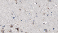 IL13RA1 / IL13R Alpha 1 Antibody - 1:100 staining human brain carcinoma tissue by IHC-P. The sample was formaldehyde fixed and a heat mediated antigen retrieval step in citrate buffer was performed. The sample was then blocked and incubated with the antibody for 1.5 hours at 22°C. An HRP conjugated goat anti-rabbit antibody was used as the secondary.