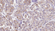 IL17C Antibody - 1:100 staining human Melanoma tissue by IHC-P. The sample was formaldehyde fixed and a heat mediated antigen retrieval step in citrate buffer was performed. The sample was then blocked and incubated with the antibody for 1.5 hours at 22°C. An HRP conjugated goat anti-rabbit antibody was used as the secondary.