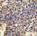 IL1A / IL-1 Alpha Antibody - Formalin-fixed and paraffin-embedded human lung carcinoma reacted with IL1A Antibody , which was peroxidase-conjugated to the secondary antibody, followed by DAB staining. This data demonstrates the use of this antibody for immunohistochemistry; clinical relevance has not been evaluated.